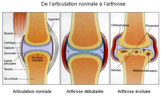 Résultat de recherche d'images pour "arthrose cartilage"
