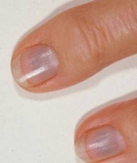 Nail abnormalities: MedlinePlus Medical Encyclopedia