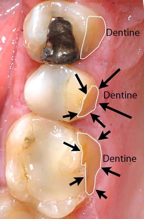 PaBe érosion dentaire boisson gazeuse-Dr Chamberland orthodontiste à Québec